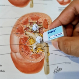 بهترین راهکارهای پیشگیری از سنگ کلیه