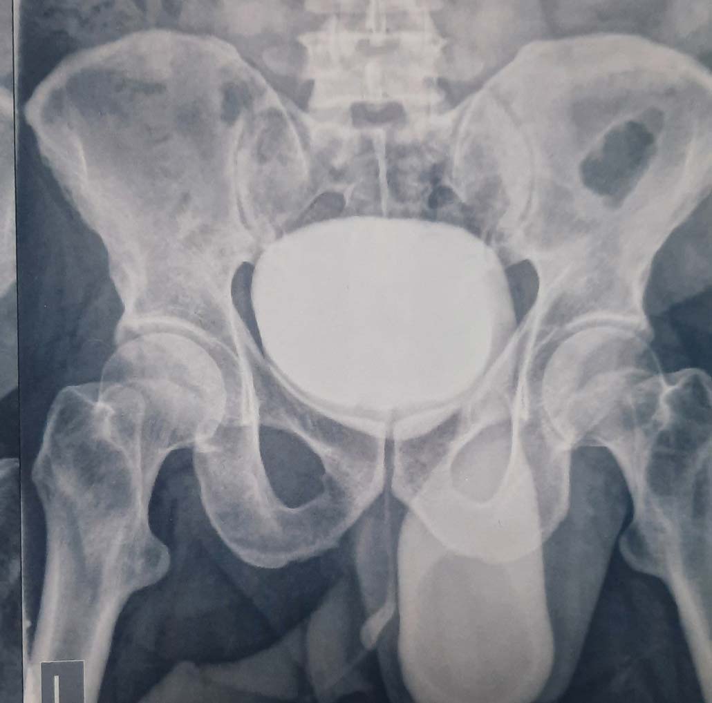 فتق مثانه Bladder hernia