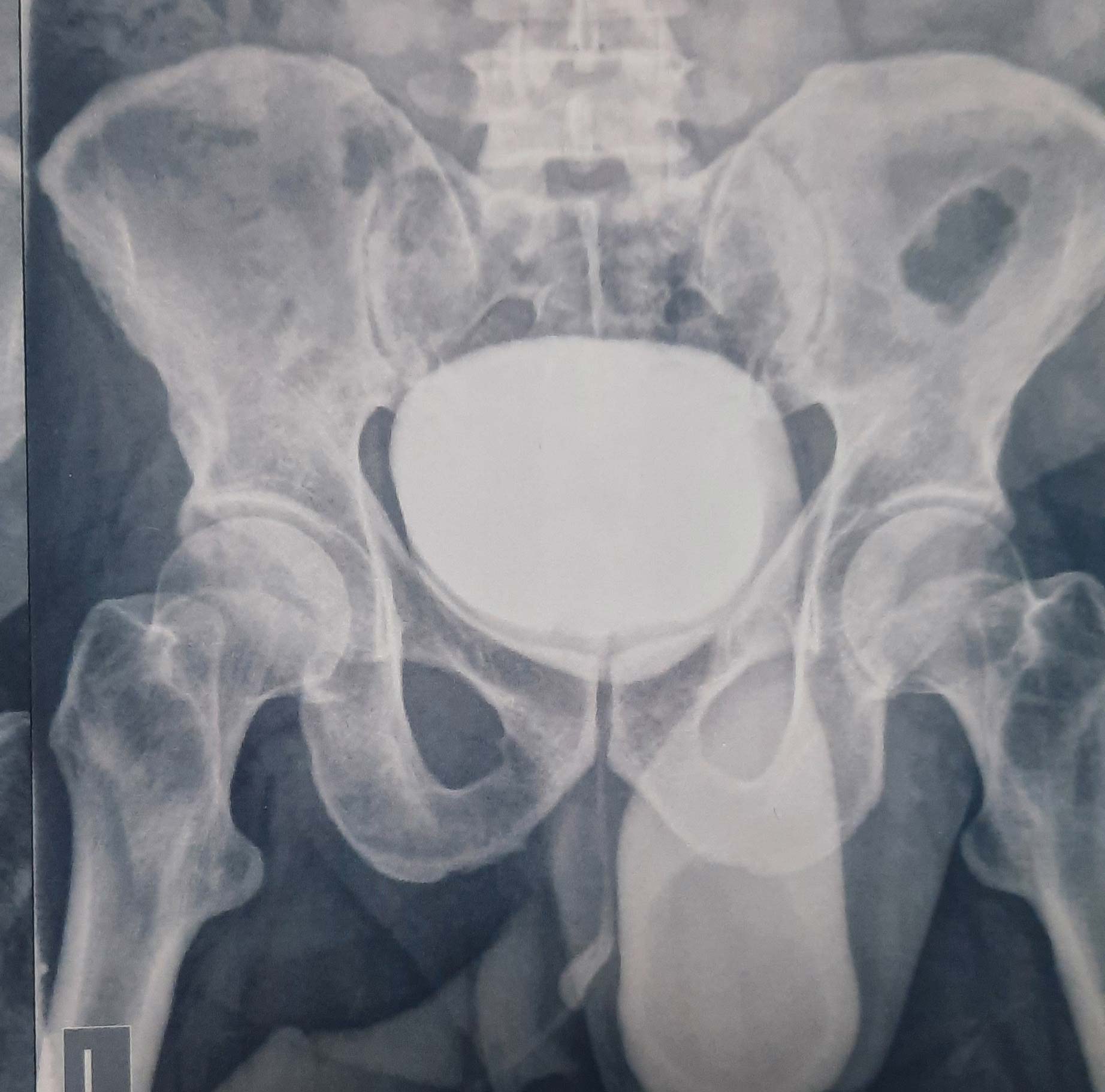فتق مثانه Bladder hernia