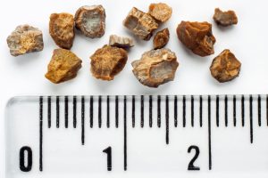 پیشگیری از تشکیل مجدد سنگ کلیه