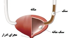 روش‌های تشخیص سنگ مثانه