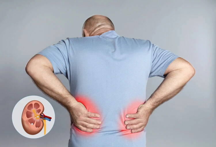 آیا سنگ کلیه باعث فشار خون می شود؟