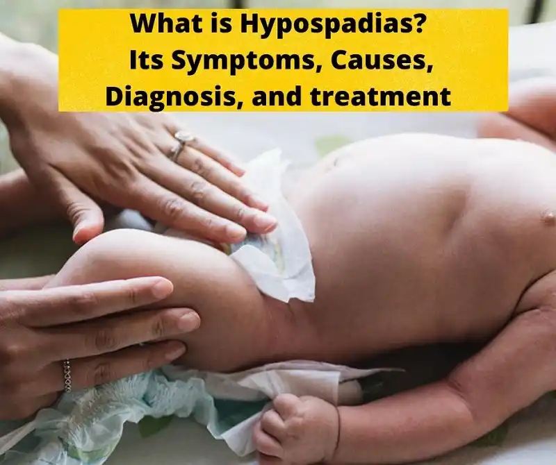 بیماری هیپوسپادیاس چیست و درمان Hypospadias