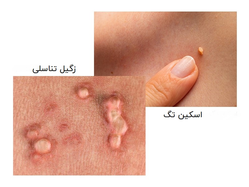 تفاوت زگیل تناسلی و گوشت اضافه