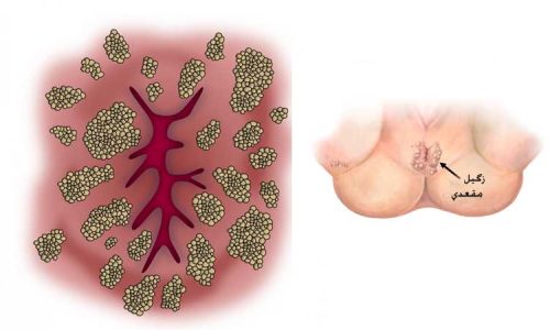 درمان زگیل تناسلی در مقعد_عفونت مقاربتی HPV