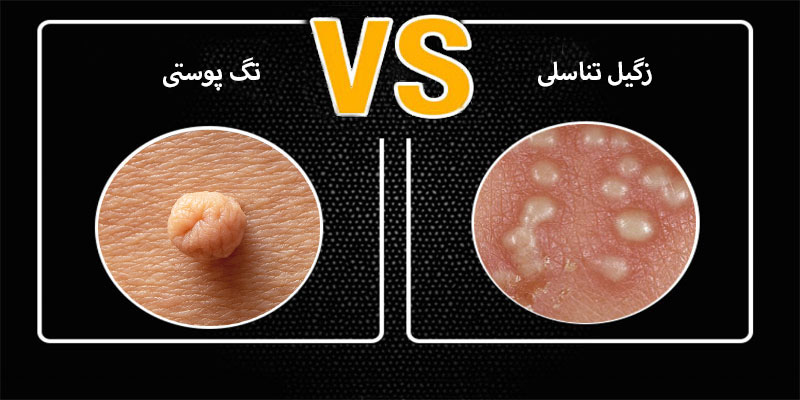 آیا گوشت اضافه همان زگیل تناسلی است؟