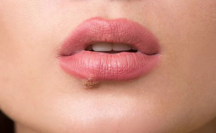 چه چیزی باعث ایجاد زگیل های مسطح می شود؟