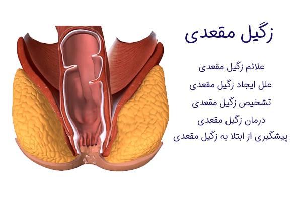 درمان زگیل تناسلی در مقعد