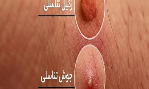 تفاوت زگیل تناسلی با ضایعات مشابه_راه‌های انتقال زگیل تناسلی